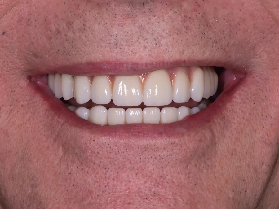 Smile after treatment, set 1