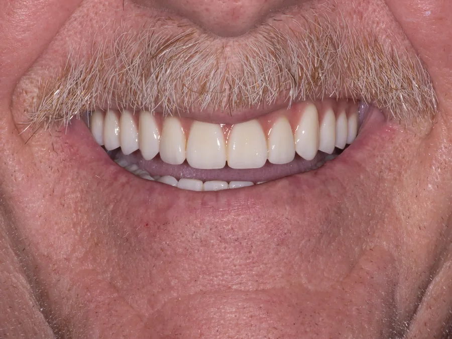 Smile after treatment, set 3