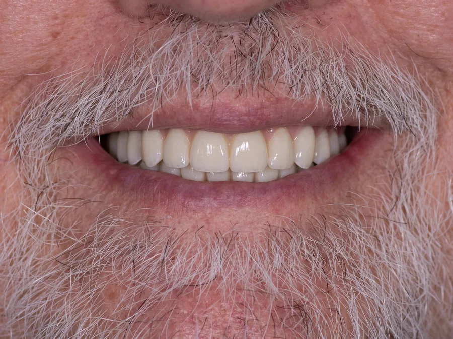 Smile after treatment, set 2